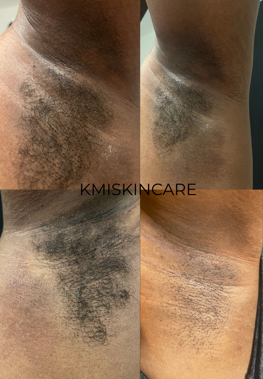 “Try It First” Armpit Detox Treatment Mask for Underarm Odor