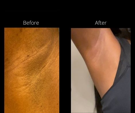 get rid of armpit odor and brighten your armpits